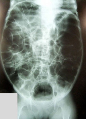 Distensão abdominal causada por gases difusa e grave que atinge o intestino delgado e o cólon.