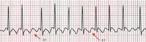 Eletrocardiograma que evidencia o padrão serrilhado do flutter atrial com condução atrioventricular 3:1 e 2:1 na derivação D2.