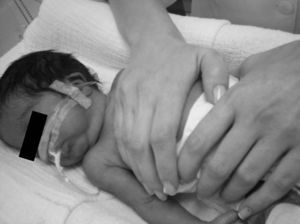 Técnica de fisioterapia respiratória do aumento do fluxo expiratório em recém‐nascidos prematuros.