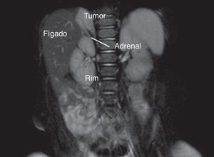 Relação estreita entre sequestro pulmonar extralobar intra‐abdominal e adrenal direita em ressonância magnética (imagens em T2).