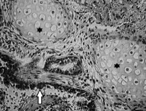 Microscopia de sequestro pulmonar extralobar intra‐abdominal que exibe epitélio respiratório (seta) e cartilagem hialina (asterisco) ampliada em 400X.
