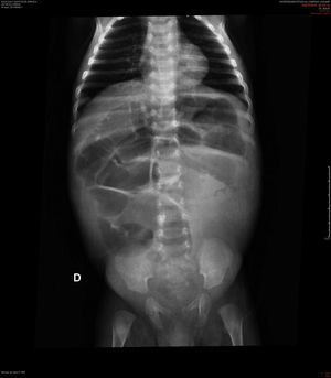 Radiografia simples de abdome, paciente de dois meses com aganglionose total do cólon, imagem pré‐operatória, mostra dilatação de alças de delgado e colônicas e pobreza de ar na região de cólons.