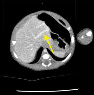 Angiotomografia de abdome – fase venosa. A seta aponta a dilatação da veia porta intra‐hepática, com o shunt portossistêmico.