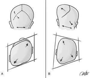 Representação de plagiocefalia posicional e plagiocefalia posterior verdadeira (sinostótica). (A) Plagiocefalia posicional que mostrando ausência de estenose de sutura lambdoide, crânio em formato de paralelogramo, bossa frontal compensatória ipsilateral, orelha ipsilateral em uma posição anterior, como se tivesse sido empurrada. (B) Plagiocefalia posterior verdadeira que mostra presença de estenose de sutura lambdoide, forma trapezoidal, abaulamento ipsilateral na região mastoide, bossa frontal compensatória contralateral; a estenose da orelha ipsilateral tende a estar em uma posição posterior e para baixo, como se a sutura a puxasse. Créditos: Patrick Braga.