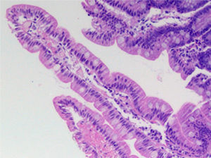 Espécime de biópsia de duodeno (Caso 2): grande aumento (100×), vilosidade digitiforme, epitélio cilíndrico com núcleo em posição basal, membrana basal preservada, células caliciformes presentes ao longo da vilosidade, infiltrado linfoplasmocitário na lâmina própria discreto.