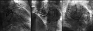 Coronariografia nas projeções oblíqua anterior direita, oblíqua anterior esquerda e oblíqua anterior esquerda caudal. Coronária esquerda com origem anômala em seio coronariano direito com trajeto retroaórtico.