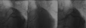 Intervenção coronária percutânea primária na artéria descendente anterior com implante de dois stents. Nota‐se artéria pequena que emite septais, porém não atinge o ápice.