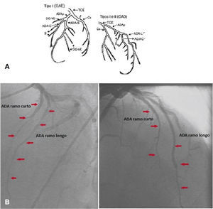Diagrama de Spindola‐Franco demonstrando artéria descendente anterior dupla tipo I (A). Coronária esquerda em projeções oblíqua anterior esquerda e direita (B). ADA: artéria descendente anterior. Fonte: Spindola‐Franco et al.1