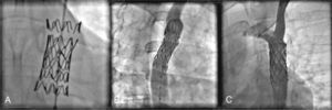 . Em (A), detalhe de um stent não recoberto Cheatham Platinum implantado há 13 anos. Notem‐se as fraturas circunferenciais da primeira e última fileira de “zigs”. Em (B), aortografia descendente em oblíqua anterior direita, mostrando linha de dissecção com pequeno aneurisma na região da primeira linha de solda fraturada. Em (C), aortografia de controle após o implante de um stent recoberto Cheatham Platinum com a exclusão do aneurisma.