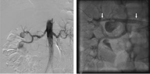 Aortografia por subtração digital e arteriografia renal final após implante do stent multicamadas. À esquerda, aortografia abdominal demonstrando fibrodisplasia renal bilateral com volumoso aneurisma renal à direita. À direita, arteriografia final após o implante do stent multicamadas. As setas indicam o início e o término do stent.