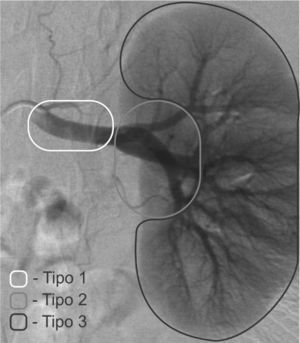 Classificação dos aneurismas renais quanto à sua localização: aneurismas do tipo 1 acometem a artéria renal principal; aneurismas do tipo 2 acometem as artérias do hilo renal; e aneurismas do tipo 3, as artérias segmentares renais intraparenquimatosas.