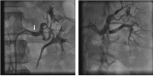 Tratamento de fibrodisplasia renal esquerda com angioplastia por balão. À esquerda, posicionamento do balão de angioplastia ao nível da lesão fibrodisplásica renal. A seta branca indica o balão de angioplastia. À direita, arteriografia final após o tratamento endovascular da fibrodisplasia renal.