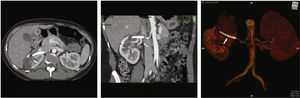 Angiotomografia pós‐operatória do tratamento do aneurisma de artéria renal direita. À esquerda, seta indica região de hipodensidade no parênquima renal direito com ausência de vascularização, compatível com infarto isquêmico renal. No painel central, seta indica a preservação de ramo segmentar renal, a partir do stent multicamadas. À direita, reconstrução volumétrica em três dimensões da aorta abdominal e artérias renais. A seta indica o posicionamento do stent multicamadas na artéria renal.