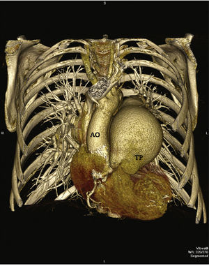 Reconstrução tridimensional da angiotomografia da artéria pulmonar. O tronco da artéria pulmonar dilatado causa deslocamento inferior da raiz da aorta. Ao: aorta; TP: tronco da artéria pulmonar.