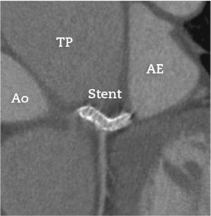 Angiotomografia coronariana realizada após 8 meses do procedimento percutâneo. Visualiza‐se o stent implantado no tronco da coronária esquerda sem sinais de compressão extrínseca pelo tronco da artéria pulmonar (TP). Ao: aorta; AE: átrio esquerdo.