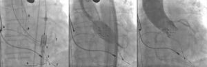 (A) À esquerda, demonstração do arsenal terapêutico: sistema de liberação da prótese balão‐expansível na aorta descendente (1) sobre fio‐guia Amplatz SuperStiff® com extremidade no ventrículo esquerdo (2); eletrodo de marca‐passo temporário no ventrículo direito (3); cateter pigtail no seio coronariano direito (4); cateter‐guia JR 6 F (5) acima do seio de Valsalva; dois fios‐guia 0,014” extrassuporte e stent coronariano posicionados distalmente na coronária direita (6); eletrodos de marca‐passo definitivo no ventrículo e átrio direitos (7 e 8). (B) Liberação da prótese valvar aórtica expansível por balão, com o sistema de angioplastia coronariana posicionado na artéria coronária direita. (C) Aortografia de controle evidenciando artérias coronarianas direita e esquerda pérvias e regurgitação mínima aórtica.