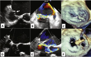Ecocardiograma transesofágico pré (A, B e C) e pós-procedimento (D, E e F). Nota-se falha de coaptação entre as cúspides (A, seta), devido a prolapso dos segmentos P2 e P3, e rotura de cordas de P2 (C, seta), ocasionando refluxo anterolateral excêntrico (B). Após implante de MitraClip® na borda medial de P2 (D e F), redução significativa do refluxo (E) e formação do duplo orifício mitral, com imagem característica em “8” ao ecocardiograma tridimensional (F).