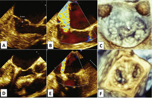 Ecocardiograma transesofágico pré (A, B e C) e pós-procedimento (D, E e F). Prolapso de ambas as cúspides associado à rotura de corda e flail do segmento A2 (A e C, seta), gerando refluxo excêntrico posterior importante (B), pelo flail gap de 4mm. Após implante de um clipe (D), redução significativa do refluxo (E) e formação do duplo orifício mitral (F).