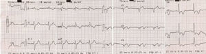 Eletrocardiograma de 12 derivações na admissão do segundo episódio de infarto do miocárdio.