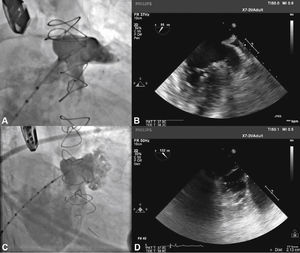 Correspondência entre as imagens angiográficas e ecocardiográficas. Em A, o apêndice atrial esquerdo visualizado em incidência oblíqua anterior direita cranial guarda semelhança com a imagem ecocardiográfica obtida com o transdutor a 55° em B. Em C, a angiografia do apêndice em oblíqua anterior direita com angulação caudal mostra melhor a porção trabecular, mais terminal, do apêndice atrial esquerdo, que se vê também em D, na imagem ecocardiográfica a 132°.