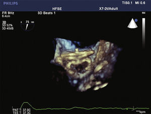 Imagem tridimensional do ecocardiograma transesofágico mostrando alguns dos sinais de adequado posicionamento do dispositivo, como a compressão do lobo, e a separação entre o lobo e o disco, que apresenta configuração côncava, ocluindo o óstio do apêndice atrial esquerdo.