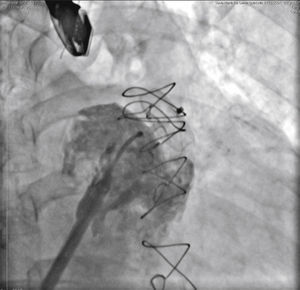 Angiografia realizada pela via lateral do sistema introdutor mostrando o disco no interior do apêndice atrial esquerdo e a completa obliteração do óstio pelo disco da prótese, ainda presa ao sistema de entrega, o que possibilitaria seu reposicionamento, caso necessário.