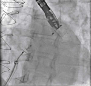 Imagens do caso 4. Visualizam‐se o AMPLATZER® Cardiac Plug 24mm ocluindo o apêndice atrial esquerdo e a prótese AMPLATZER® PFO Occluder 25mm posicionada através do forame oval da paciente. Para o implante da prótese AMPLATZER® PFO Occluder, foi utilizada a mesma bainha de dupla curvatura usada para o implante do AMPLATZER® Cardiac Plug.