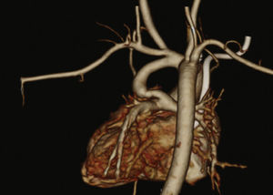 Angiotomografia de coração e grandes vasos em caso de atresia pulmonar e comunicação interventricular.