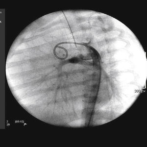 Abordagem arterial femoral (técnica de Seldinger). Aortografia em caso de atresia pulmonar e comunicação interventricular (idade: 32 dias; peso: 3.950g).