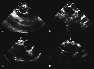Oclusão percutânea da comunicação interatrial. (A) Visualização do balão para medida do diâmetro distendido da comunicação interatrial. (B) Bainha longa visualizada dentro do átrio esquerdo. (C) Visualização da prótese em eixo curto. (D) Visualização da prótese liberada no corte das cavas.