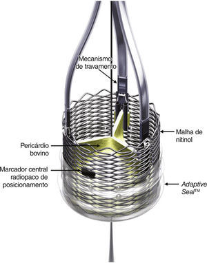 A válvula Lotus™ é composta por três folhetos de pericárdio bovino suturados a uma armação de nitinol. Possui uma marca radiopaca em posição central, que auxilia no posicionamento, e um dispositivo de selamento de poliuretano/policarbonato, cuja função é se adaptar à anatomia do anel valvar e minimizar a regurgitação paravalvar. O dispositivo é expansível mecanicamente e atinge a conformação final pelo acionamento dos mecanismos de travamento, localizados em cada ponto de inserção dos folheto.