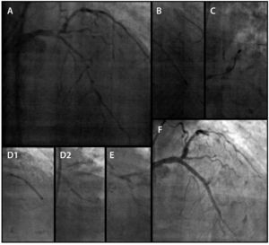 Coronariografia esquerda (A). Aterectomia rotacional para as artérias descendente anterior (B) e circunflexa (C). Implante de stents em descendente anterior (D1 e D2), no tronco de coronária esquerda e circunflexa (E). Resultado angiográfico (F).