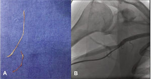 (A) Fragmentos de tecido retirados durante a lavagem do cateter angiográfico. (B) Arteriografia radial direita mostrando origem axilar da artéria radial direita.