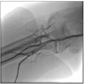 Arteriografia radial direita após término do procedimento, mostrando artéria radial direita pérvia.