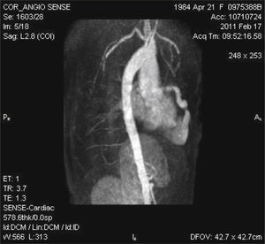 Angiografia com ressonância magnética demonstra importante dilatação da artéria descendente anterior em comunicação com a região apical do ventrículo direito. Esta região não se encontra conectada com o restante da cavidade ventricular.