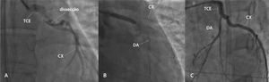 (A) Lesão com aspecto de dissecção espontânea em tronco de coronária esquerda (TCE), com fluxo mínimo nas artérias descendente anterior (DA) e circunflexa (CX). (B) Intervenção coronária percutânea com implante de um stent não farmacológico em TCE. (C) Resultado após a intervenção coronária percutânea.