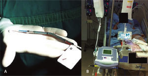 (A) Dispositivo de assistência ventricular Impella® 2.5. (B) Dispositivo de assistência ventricular Impella® 2.5 instalado.