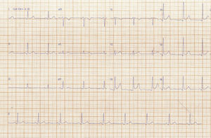 Eletrocardiograma de admissão na unidade de dor torácica.