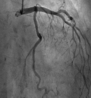 Arteriografía coronaria de coronaria izquierda sin lesiones significativas.