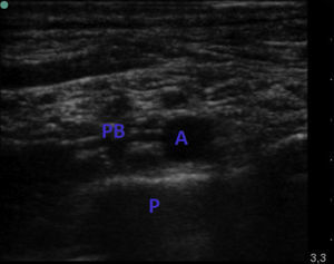 Bloqueo supraclavicular. PB: plexo braquial; A: arteria; P: pleura.