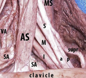 Plexo braquial a nivel supraclavicular. Supr: nervio supraclavicular. Fotografía cortesía de Dr. Carlo Franco. Reproducida con permiso.