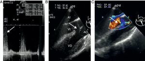 Precorrección. A) Doppler continuo del tracto de salida del ventrículo derecho (TSVD) con gradientes pico de 66mmHg y medio de 29mmHg en un transgástrico profundo del ventrículo derecho (Deep TG RV); la flecha señala el gradiente pico. B) El eje largo de la válvula aórtica en el esófago medio (ME AV LAX) muestra las características clásicas de la tetralogía de Fallot: aorta cabalgante y comunicación interventricular (CIV) amplia; la flecha señala la CIV. C) El doppler color de la vista previa demuestra un cortocircuito de derecha a izquierda; la flecha señala el trastorno de flujo. AI: aurícula izquierda; AO: aorta; VD: ventrículo derecho; VI: ventrículo izquierdo.