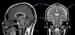 Resonancia magnética cerebral. a) Engrosamiento dural difuso. b) Herniación de amígdalas cerebelosas. c) Colecciones subdurales frontotemporales bilaterales. d) Edema cerebral difuso.
