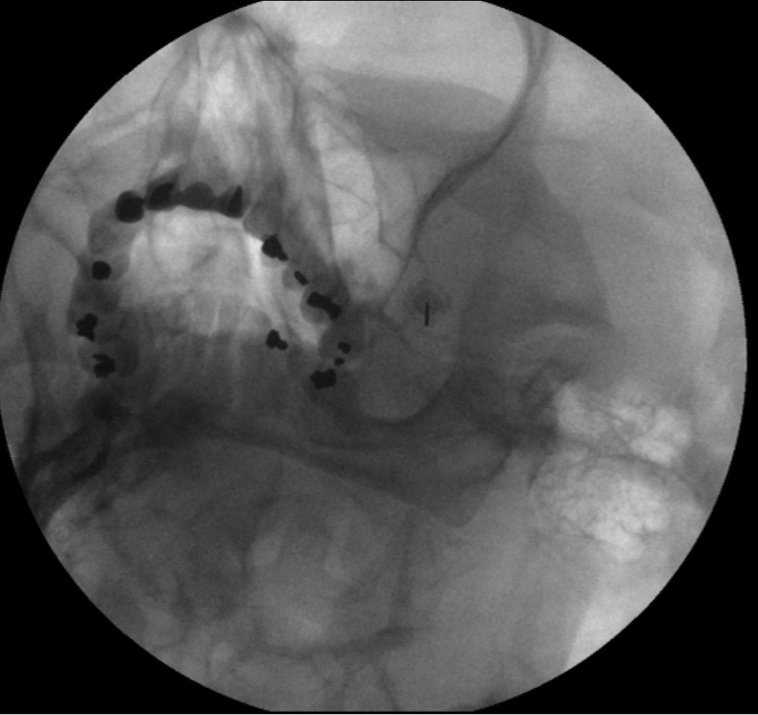 Radiofrecuencia térmica del ganglio de Gasser en pacientes con ...