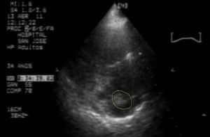 Ecocardiograma torácico con aparente masa insertada en el catéter venoso central en la aurícula derecha.
