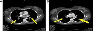 Tomografía computarizada de tórax. A) Trombo en las arterias lobares segmentarias. B) Trombo en las arterias pulmonares principales.