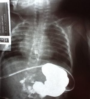 Radiografía de tórax con medio de contraste por gastrostomía. Fístula traqueoesofágica y obstrucción subglótica de la vía aérea.