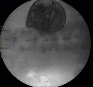 Fluoroscopia de la bomba implantada. Fuente: autores.
