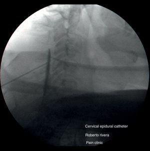 Catéter epidural cervical guiado por fluoroscopia. Se observa la aguja en C4-C5 y el medio de contraste con un patrón epidural típico. Fuente: autores.