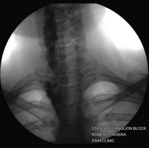 Bloqueo del ganglio estrellado y de la cadena simpática torácica guiado por fluoroscopia, confirmado con medio de contraste. Fuente: autores.